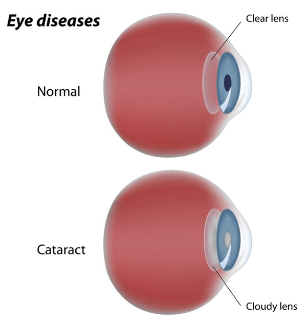 Cataract Removal in Sugar Hill
