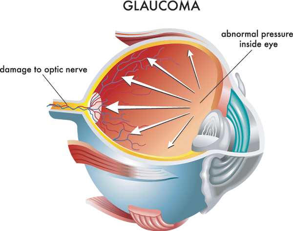 Glaucoma Treatment in Sugar Hill