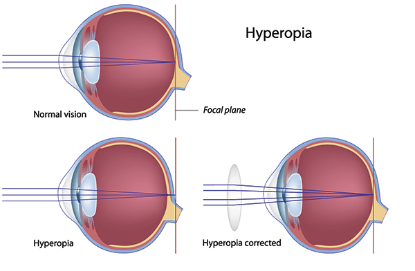 Corrective Lenses in Washington Heights