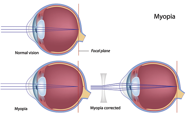 Highbridge Park Nearsightedness