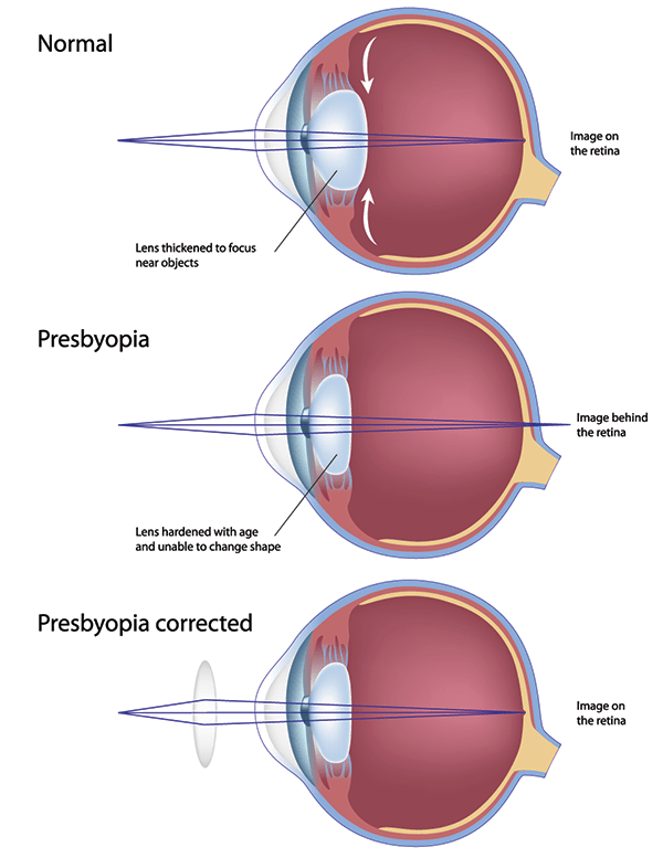 Corrective Lenses in Washington Heights