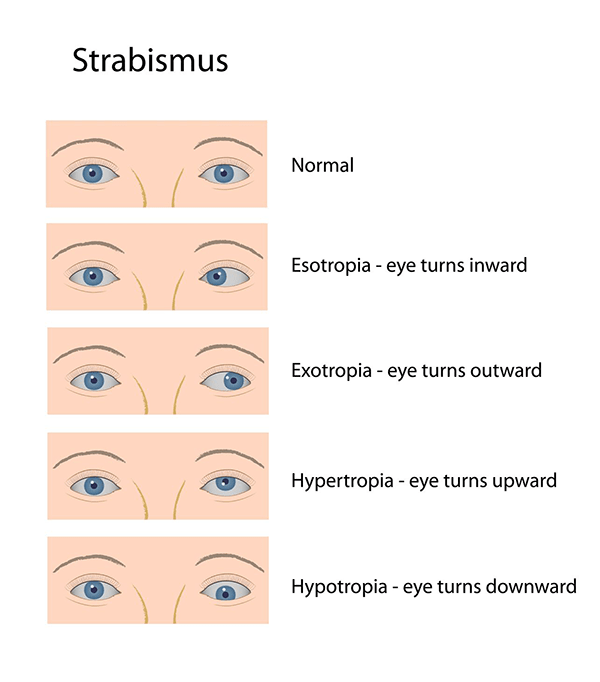 Sugar Hill Crossed Eyes